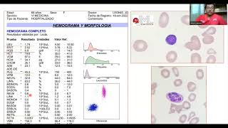 PANCITOPENIA EN ANEMIA MEGALOBLÁSTICA APRENDIZAJE BASADO EN CASO CLÍNICO [upl. by Berman163]