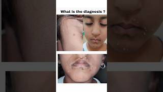 Diagnosis and treatment of Molluscum Contagiosum [upl. by Cirad]