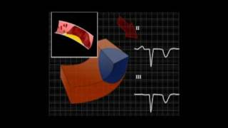 EKG zawał 1 [upl. by Swithbert]