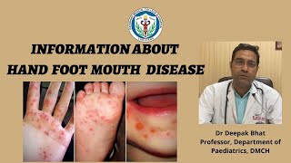 Information about Hand Foot amp Mouth Disease II Awareness II Prevention II Treatment II DMCH [upl. by Gensler]