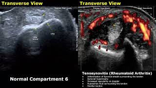 Wrist Hand amp Finger Ultrasound Normal Vs Abnormal Images  Tenosynovitis Rheumatoid Arthritis USG [upl. by Hildagard]