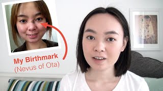 I Had a Birthmark on My Face  4 Years After Removal Nevus of Ota [upl. by Sotsirhc]