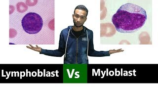 Myeloblast Vs Lymphoblast Comparison [upl. by Ynahteb]