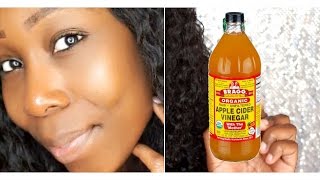 How To Get Clear Glowing Skin In 7 Days DIY ACV Toner [upl. by Anilehcim490]