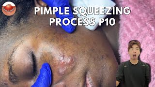 The MOST TERRIFYING Acne Squeezing Videos Youve Ever Seen 10 [upl. by Nosnar]