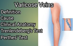 Varicose veins [upl. by Aerdnna]