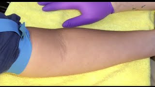 Tips For Locating Difficult Veins [upl. by Lambart]