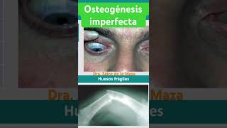 Osteogénesis Imperfecta [upl. by Nedra]