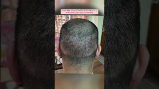 Hair Transplant Results  Medlinks Hair Transplant hairtransplantresults shortsfeed short [upl. by Cain]