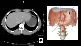 Axial CT Abdomen [upl. by Herzel119]