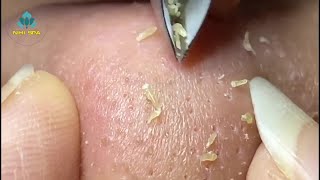 Best Satisfying Nose Plucking Blackheads Whiteheads Removal  Acne Treatment 10 [upl. by Ahearn]