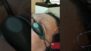 QSwitch Laser Treatment for Pigmentation  Dr Priyanka Aggarwal  Dermatologist [upl. by Iana]