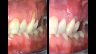 Treatment for Receding Gums [upl. by Linkoski]