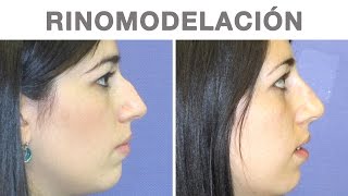 Rinomodelación  Rinoplastia Sin Cirugía  Testimonio de María José [upl. by Vallo]