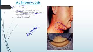 Actinomyces [upl. by Jepson]