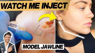 Jaw Filler Before amp After With Procedure  Technique Needle [upl. by Gregoor]