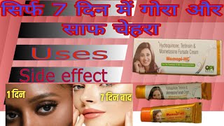 MemopiHC Cream Uses In Hindi  Hydroquinone Tretinoin Mometasone Furoate Cream Benefits amp Side E [upl. by Emoreg]