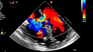 Atrial Septal Defect Primum Echocardiography [upl. by Oralle]