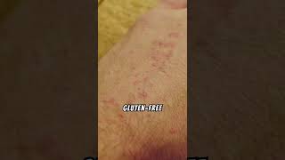 Dermatitis Herpetiformis Relief [upl. by Kinelski510]