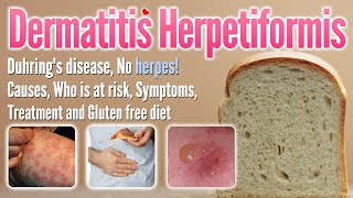 Dermatitis herpetiformis Causes Symptoms Treatment and glutenfree diet list  Duhring’s disease [upl. by Xed]