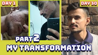 My acne story  Transformation in 30 days  PART 2  Hindi हिन्दी 🔥 [upl. by Watt814]