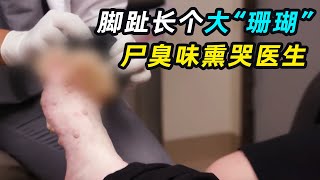 男子脚上长个“大珊瑚”，味道刺鼻，熏哭医生！ [upl. by Bradstreet]