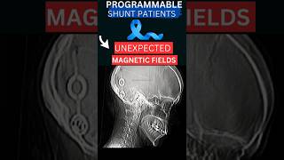 🧠 Unexpected Magnetic Fields changing VP shunt settings Be Cautious ⚠️ [upl. by Klimesh]