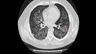 Centrilobular pathology on high resolution chest CT HRCT [upl. by Bunce974]