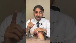 Low Level Laser Therapy For Hair Loss  Dr Rahul Jagiasi  Hindi [upl. by Eresed966]