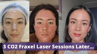 CO2 Fraxel Laser Review 3 Sessions Later  Did My Old Atrophic Acne Scars Improve  michxmash [upl. by Oza413]