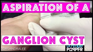 Aspiration of a ganglion cyst [upl. by Katz165]