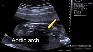 Understanding your fetal ultrasound [upl. by Valdes551]