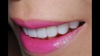 Video of Dental Veneers Procedure To a Young Patient at Cosmetic Dental Associates [upl. by Bela]