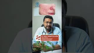 മുഖക്കുരു പാടുകൾ എങ്ങനെ എളുപ്പത്തിൽ മാറ്റാം  Acne Scars Treatment Malayalam [upl. by Neitsabes917]