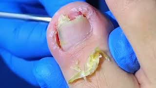 Trimming Removing Dead Skin and Huge Ingrown Toenails [upl. by Analihp]