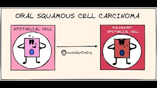 Oral squamous cell carcinoma  Etiology and Pathogenesis [upl. by Ahsika]