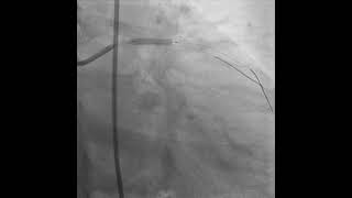 PROVISIONAL STENTING OF LAD  D1 BIFURCATION [upl. by Selina]