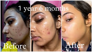 Pimples Removal Journey  Tretinoin before and after  all unfiltered photos and videos [upl. by Aitak]