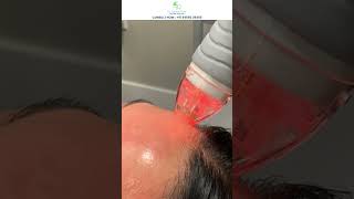 Microneedling amp PRF Therapy for Flawless Skin  Dr Gautam Rekhi  Skin amp Hair Specialist [upl. by Hola]