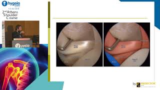 Arthroscopic Anatomy of the Shoulder  G Skarpas  Όμιλος Υγεία [upl. by Ellekcir]