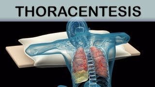 Thoracentesis Medical Animation [upl. by Enaenaj]