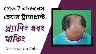 গ্রেড 7 বাল্ডনেস হেয়ার ট্রান্সপ্লান্ট প্ল্যানিং এবং মাকিং  ডা জয়ন্ত বাইন [upl. by Ymrej]