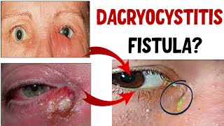 DACRYOCYSTITIS Lacrimal Sac Infection Stages Complications and Treatment [upl. by Kareem]