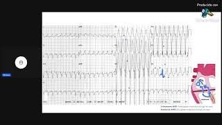 Taquicardias Supraventriculares  Clase 8 Casos clínicos Primera Parte [upl. by Michella]