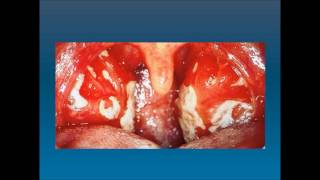 Mononucleosis infecciosa Enfermedad del beso [upl. by Bengt]