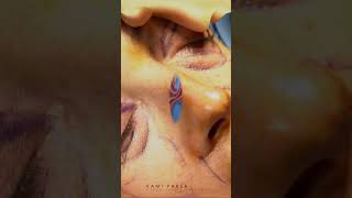 How Its Done Upper and Lower Eyelid Surgery with Dr Kami Parsa [upl. by Alene]