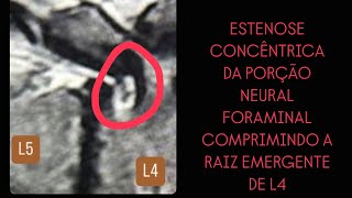 02102024  TF L4L5  HERNIA FORAMINAL CALCIFICADA  COMPRESSÃO RAIZ EMERGENTE DE L4 [upl. by Adala167]