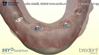 Immediate loading procedure for bredent implants  Fixed Teeth in 24 Hours [upl. by Spike236]