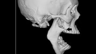 خلع مفصل الفكين Temporomandibular joint dislocation [upl. by Nairad]