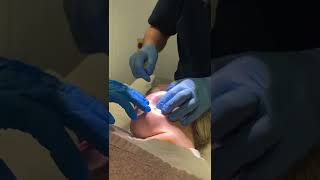 Dermatofibroma lesion removal at The Doctors Laser Clinic Norwich [upl. by Iseabal]